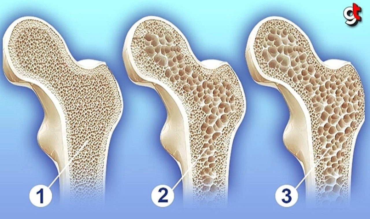 Kemik erimesi nasıl olur, taedavisi nasıl yapılır?