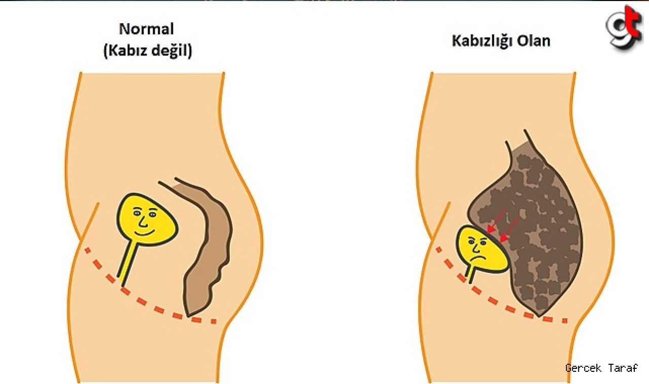 Çocuklar neden kabız olur?