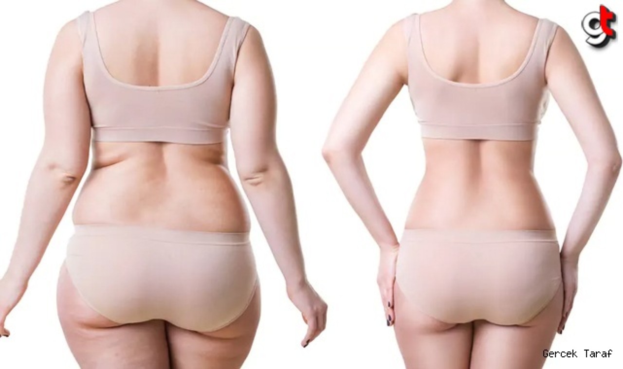 Liposuction