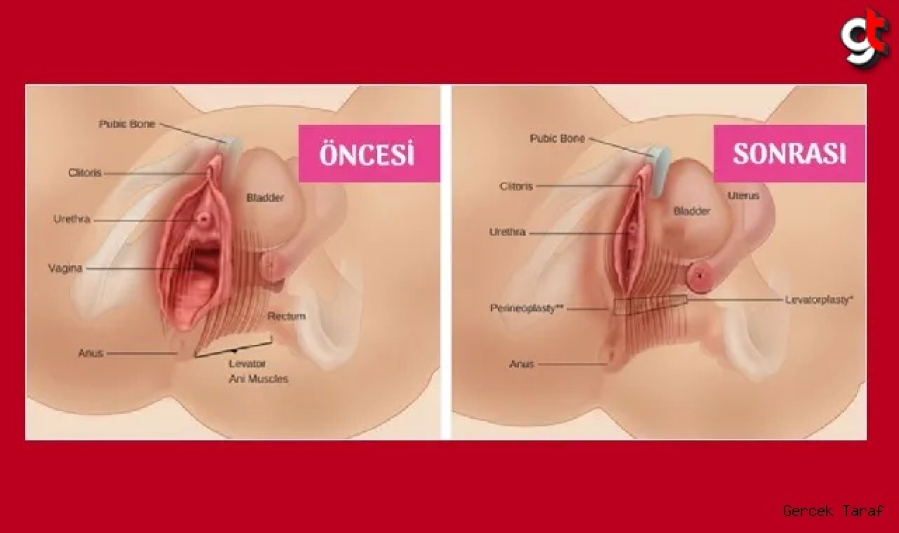 Vajinoplasti nedir? Nasıl yapılır? Kimler Vajinoplasti için uygundur?