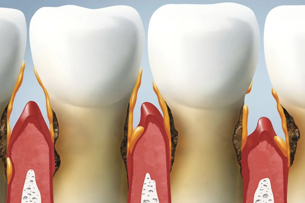 Agresif Periodontitis: Erken Teşhis Edilmezse Diş ve Çene Kaybına Yol Açıyor