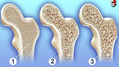 Kemik erimesi nasıl olur, taedavisi nasıl yapılır?