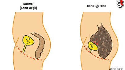 Çocuklar neden kabız olur?