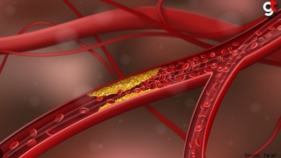 Damar Sertliği Neden Olur? Nelere Dikkat Edilmeli? Nelerden Uzak Durulmalı?