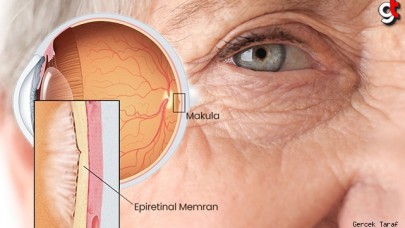 Göz hastalıklarında Epiretinal Membran Nedir?