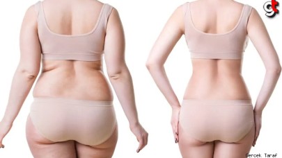 Liposuction