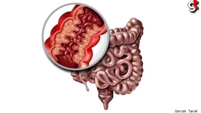 Crohn Hastalığı Nedir? Nasıl Beslenmeliyiz? Nelerden Kaçınmalıyız?