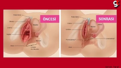 Vajinoplasti nedir? Nasıl yapılır? Kimler Vajinoplasti için uygundur?