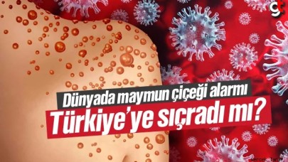 Dünya alarma geçti, maymun çiçeği hastalığı nedir Türkiye'de var mı?