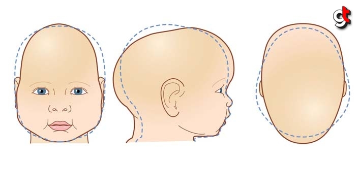 Bebeğin kafasında şekil bozukluğu varsa dikkat edin