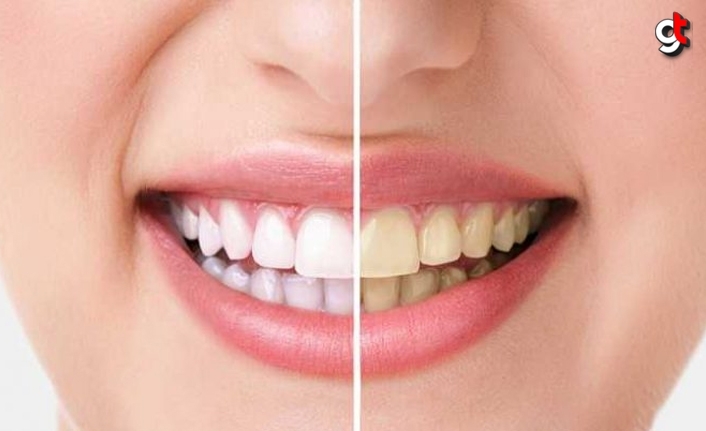 Diş Beyazlatma Tedavisi (Bleaching) Nedir?