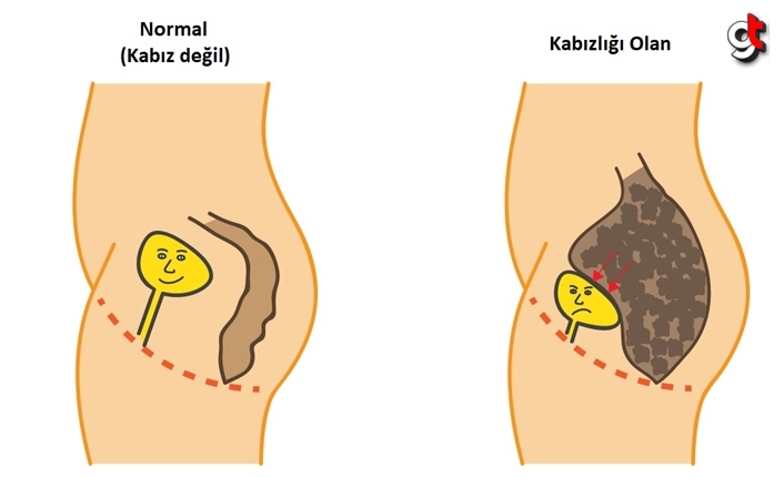 Kabızlıktan nasıl kurtulunur, tedavisi nedir?