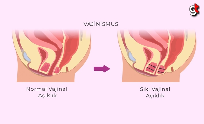 Vajinismus nedir ve nasıl tedavi edilir?