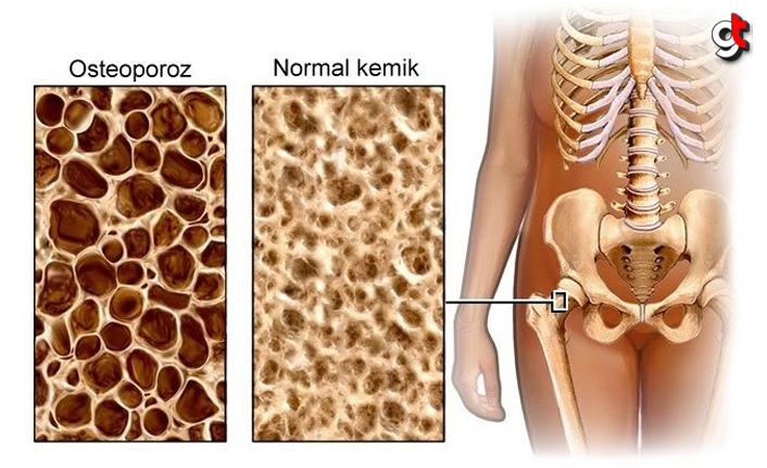 Kemik Erimesi Neden Olur? Kemiklerimizi Nasıl Koruruz?