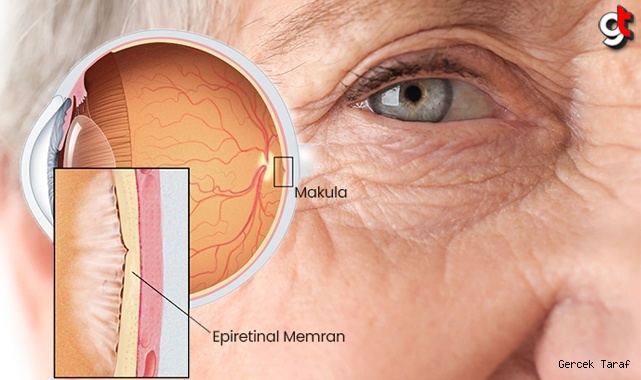 Göz hastalıklarında Epiretinal Membran Nedir?