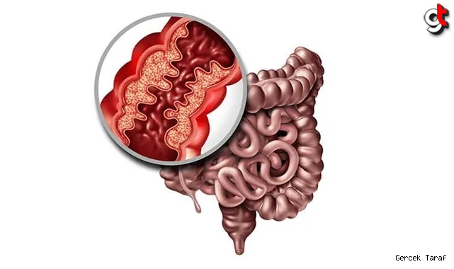 Crohn Hastalığı Nedir? Nasıl Beslenmeliyiz? Nelerden Kaçınmalıyız?